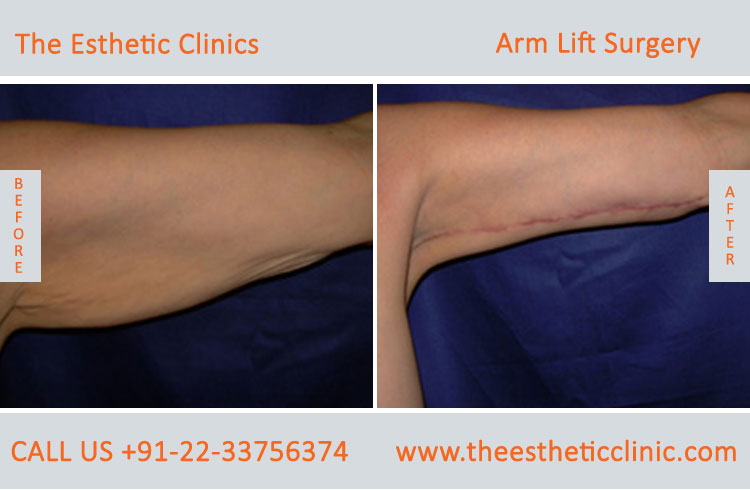 Arm Lift Surgery, Brachioplasty before after photos in mumbai india (4)